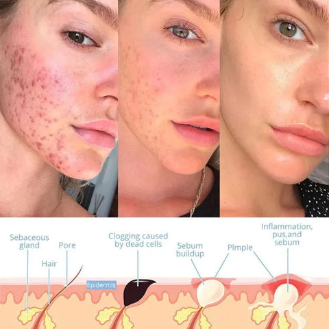 Venziraa™ High-Frequency Facial Wand